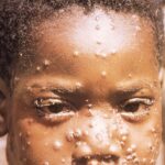 Face of young boy with characteristic maculopapular mpox cutaneous rash