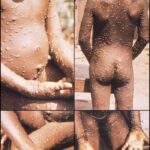 Face, back, hands, and feet of young boy with characteristic maculopapular mpox cutaneous rash