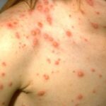 An adolescent female's shoulder and chest with chickenpox (varicella) lesions at various stages.