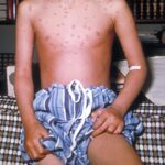 Chickenpox lesions on the torso of four-year-old child sitting on the edge of a bed on day 5 of his illness.