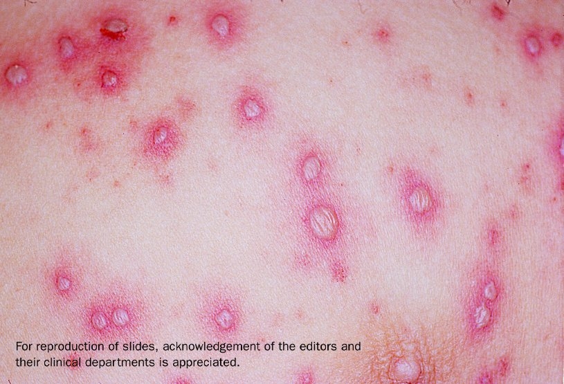 Close-up of chickenpox lesions on the skin.
