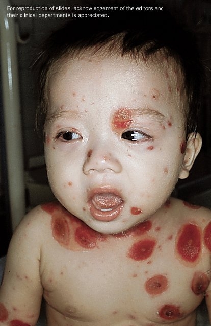 A toddler with bullous chickenpox on the face and upper body.