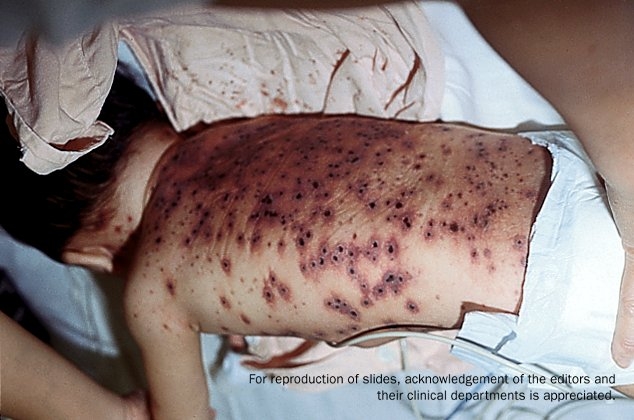 A child in bed on his stomach, showing severe bullous chickenpox.