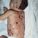 A young child in a hospital bed with his back showing hemorrhagic chickenpox.